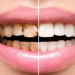 full-mouth-rehabilitation